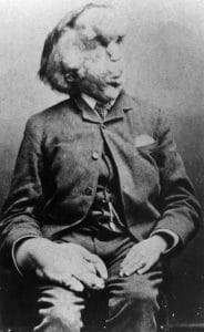 A black-and-white photograph of a seated man in a suit with severe facial and hand deformities, looking slightly to the side, hands resting on his lap.