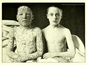 Two boys sit side by side; the boy on the left has his face and torso covered in pustules from smallpox, while the boy on the right appears healthy and has clear skin. Both are shirtless and look toward the camera.